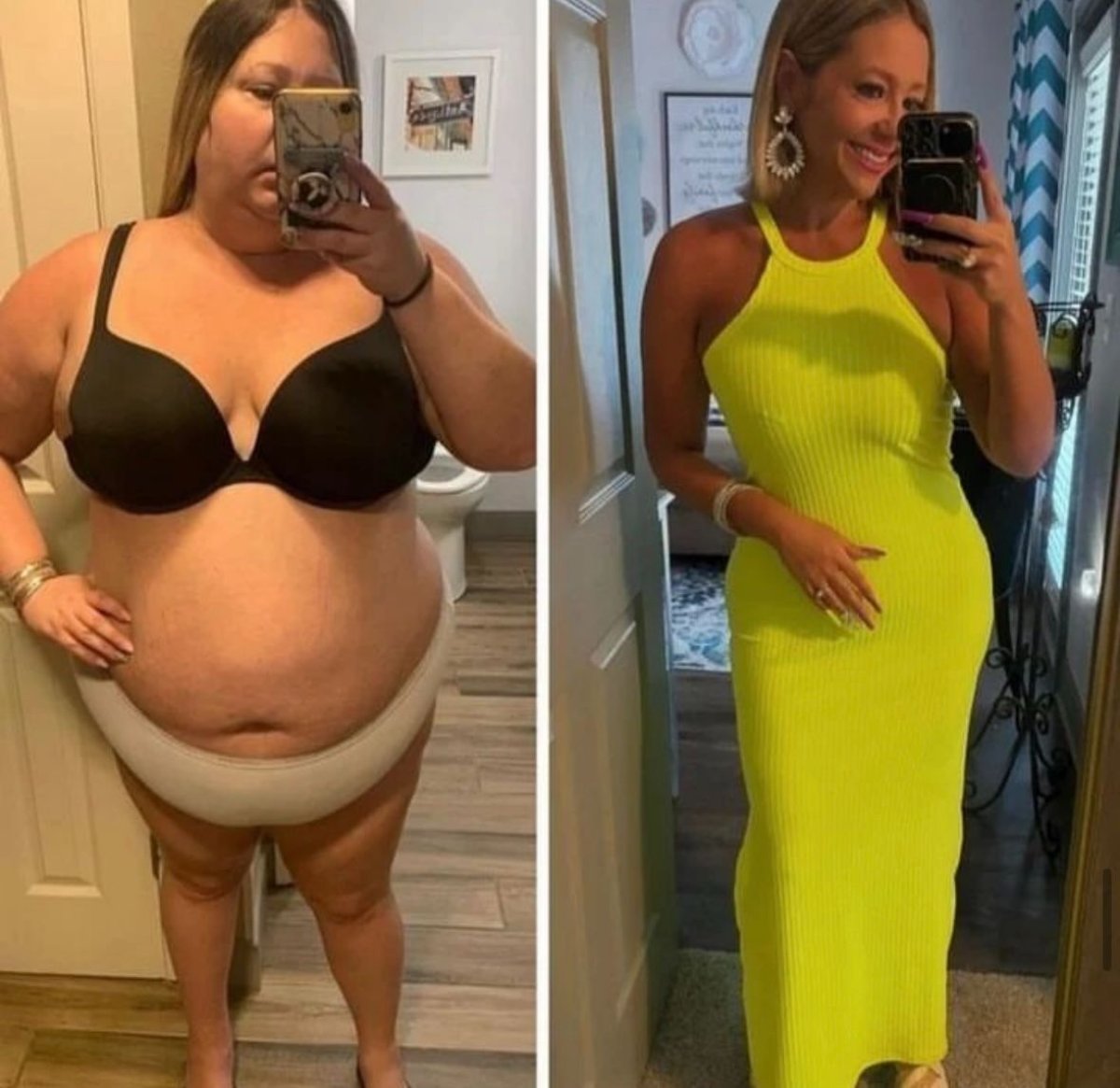 Before and after gastric sleeve surgery at ÜMRAN TIP MERKEZİ – visible weight loss results