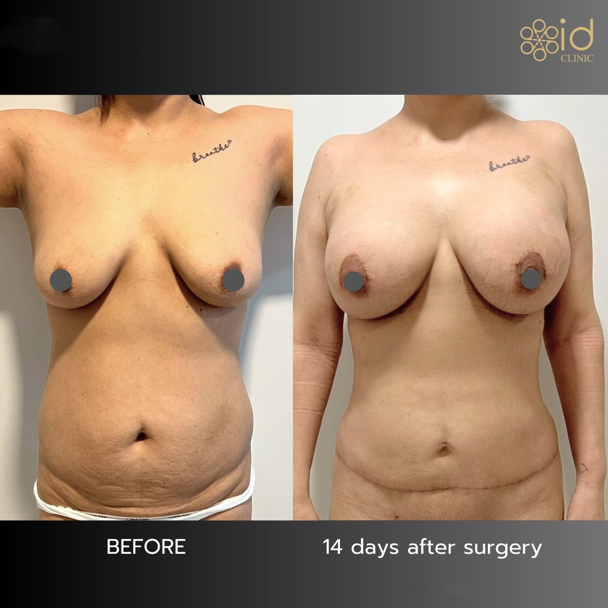 Before and after tummy tuck and breast lift results at ID Clinic Bangkok, 14 days post-op