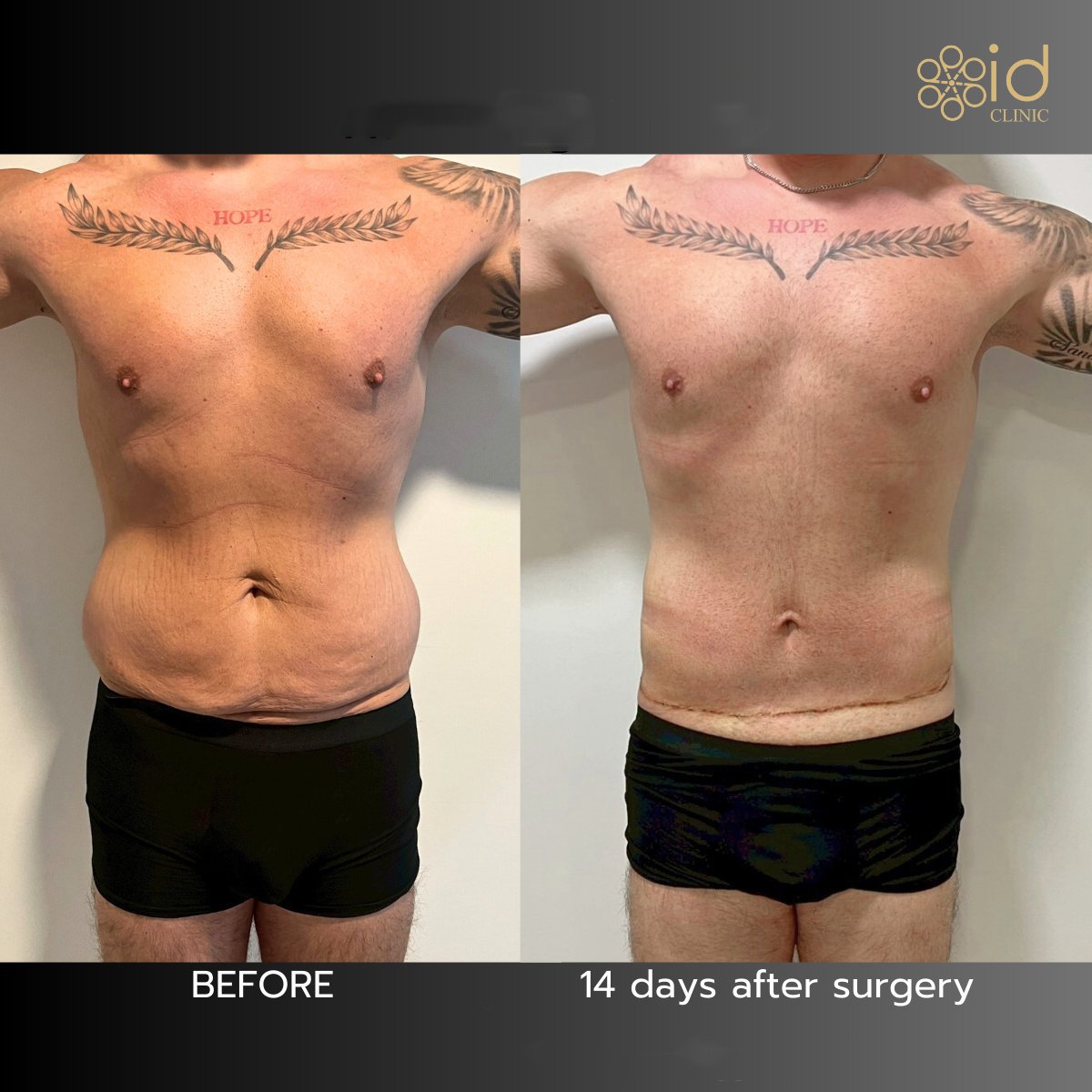 Before and after tummy tuck results at ID Clinic Bangkok, flatter abdomen after 14 days