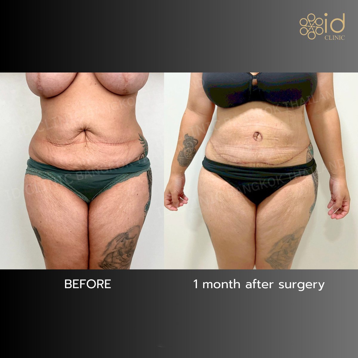 Before and after tummy tuck results at ID Clinic Bangkok, visible abdominal contour improvement