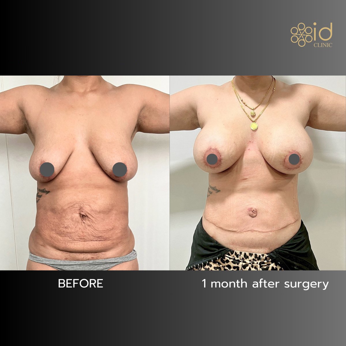Before and after tummy tuck results at ID Clinic Bangkok, visible abdominal contour improvement