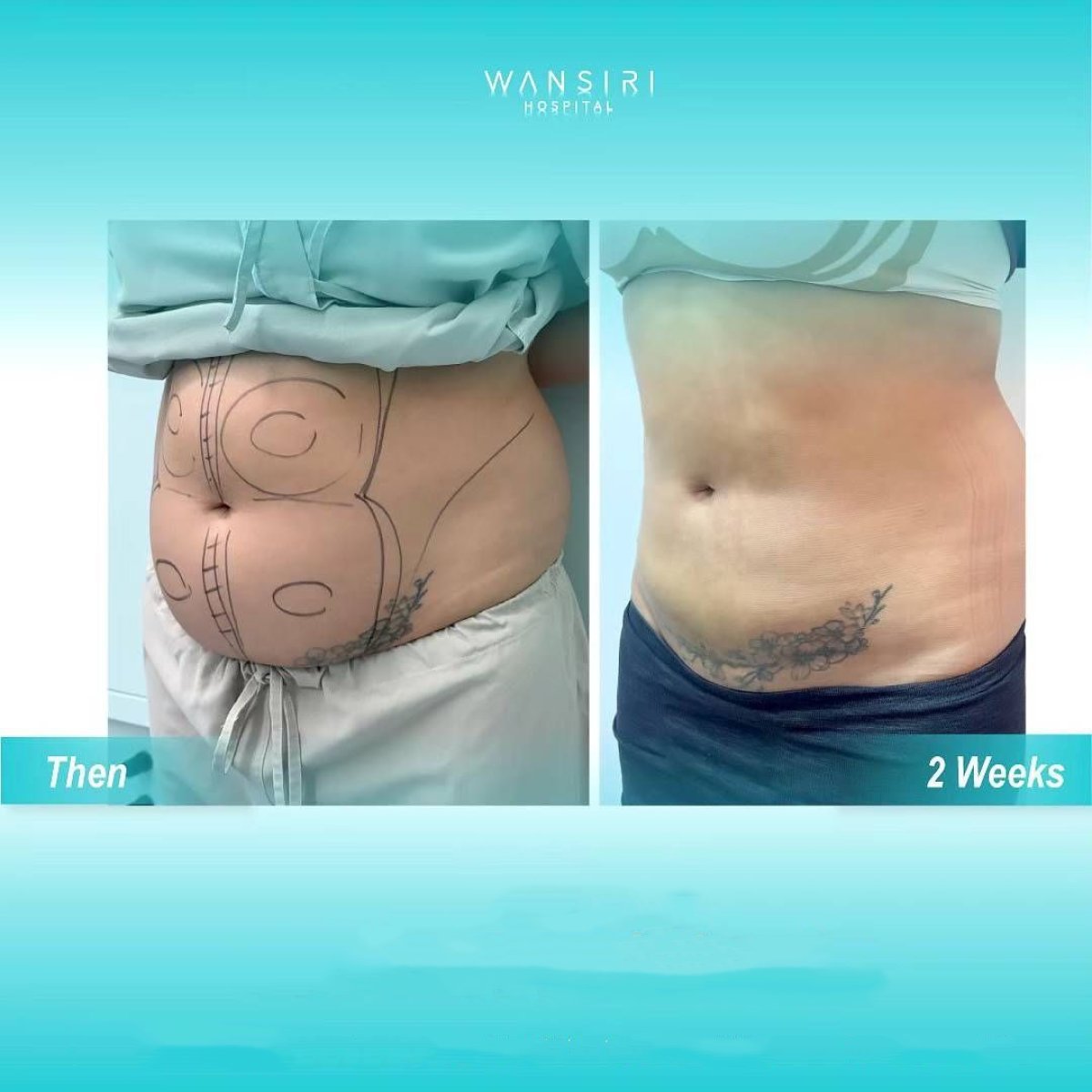 Before and after liposuction results at Wansiri Hospital, visible abdominal contour improvement