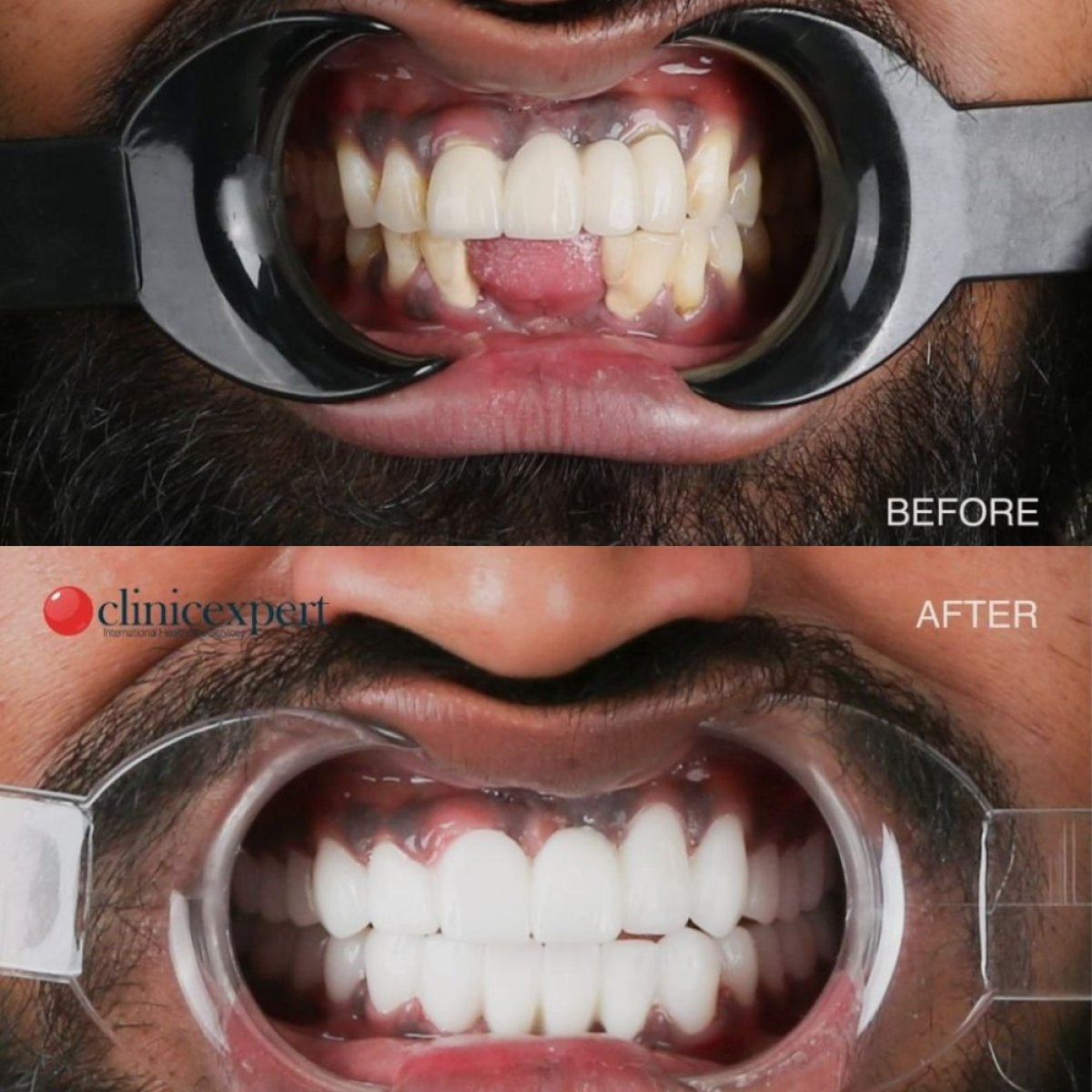 Resultados antes y después de Hollywood Smile en CE International Hospital, transformación con carillas