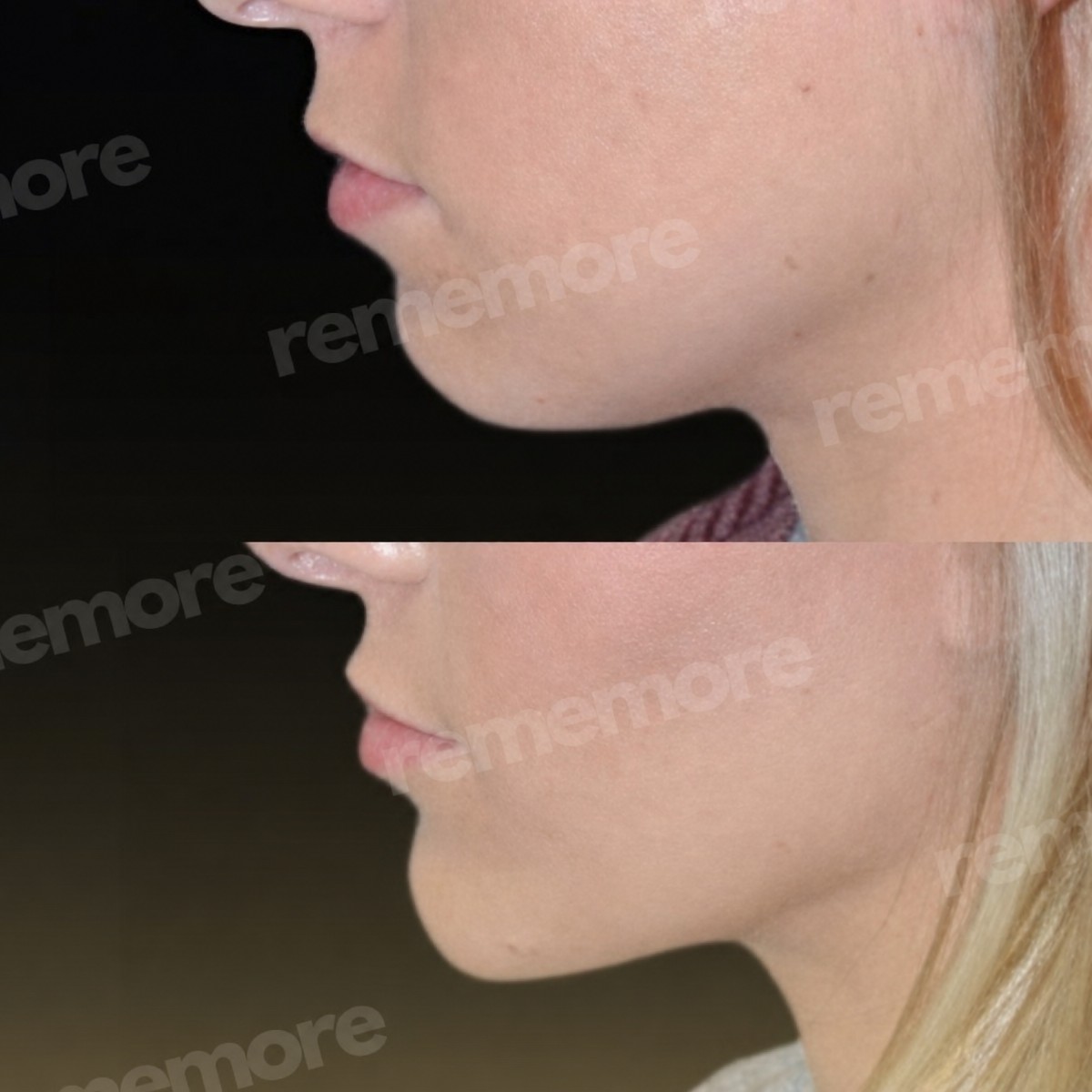 Before and after chin implant results at Memorial Şişli Hospital, improved chin contour