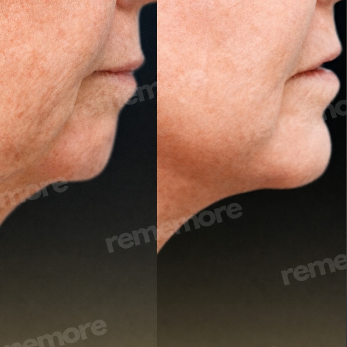 Before and after chin implant results at Memorial Şişli Hospital, improved chin contour