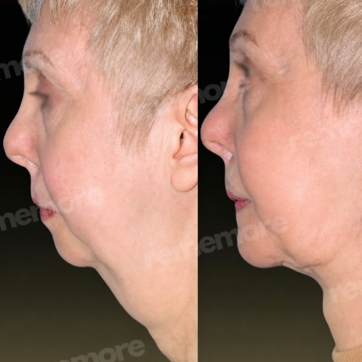Before and after chin implant results at Memorial Şişli Hospital, improved chin profile