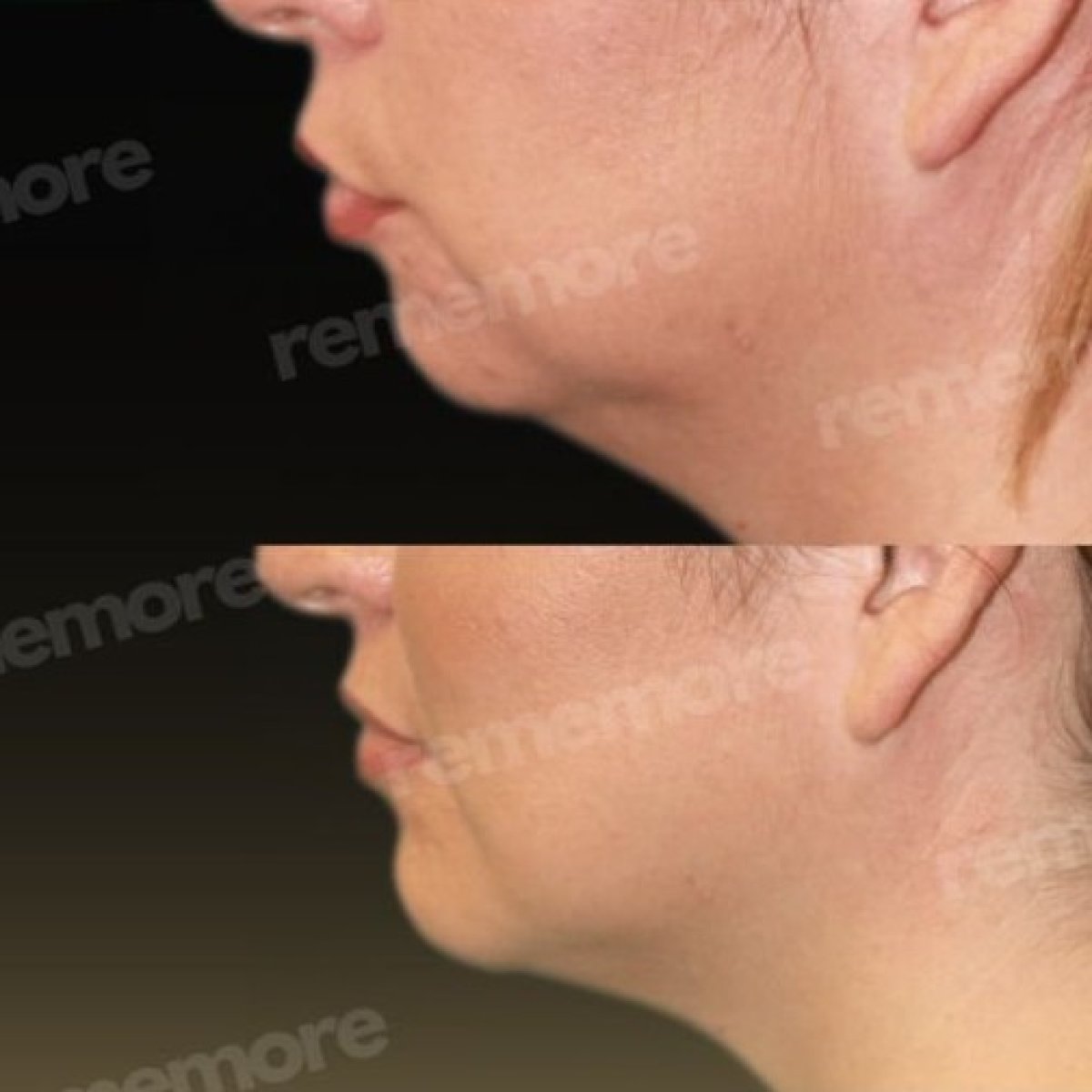 Before and after chin implant results at Memorial Şişli Hospital, improved chin contour