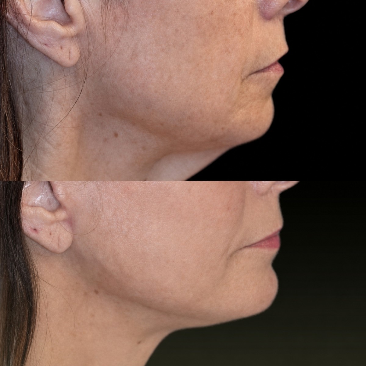 Before and after chin implant results at Memorial Şişli Hospital, improved chin contour