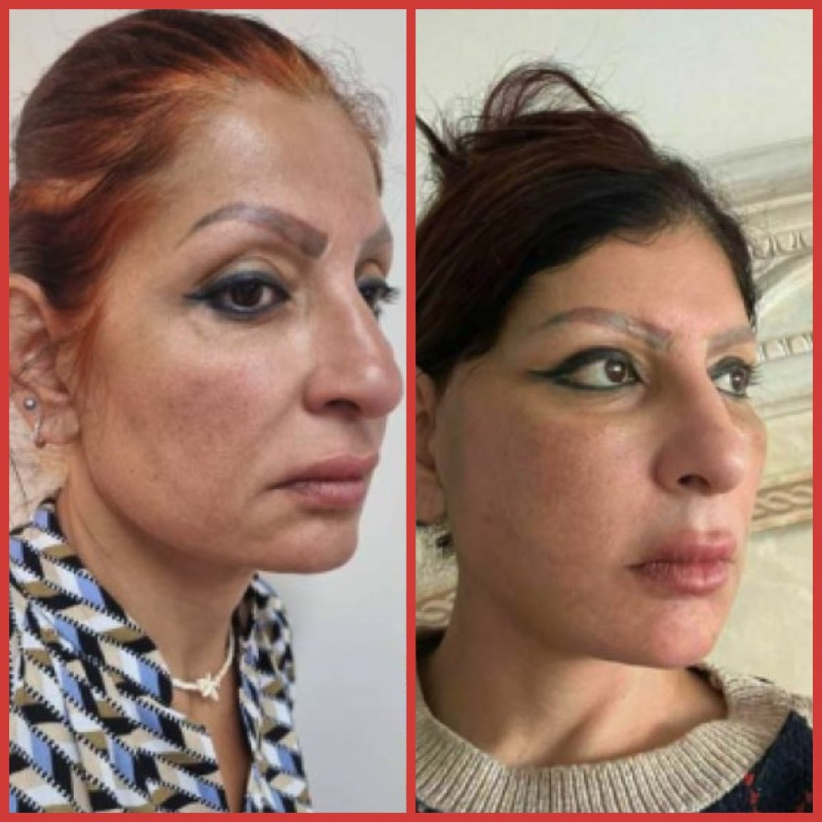 Resultados de lifting facial antes y después en DGB Clinic, rejuvenecimiento visible