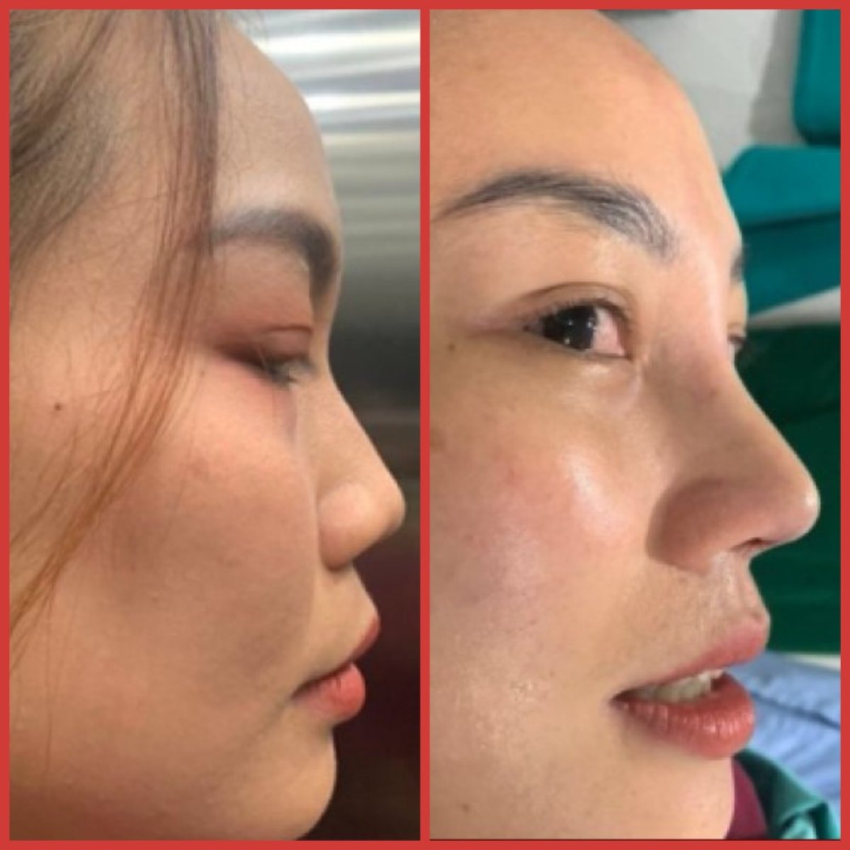 Resultados de rinoplastia antes y después en DGB Clinic, perfil nasal natural