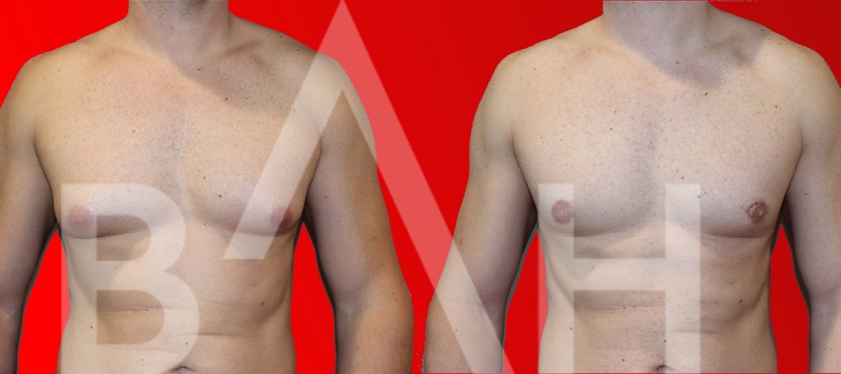 Résultats avant/après chirurgie gynécomastie chez Büyük Anadolu Hospitals (BAH), torse masculin