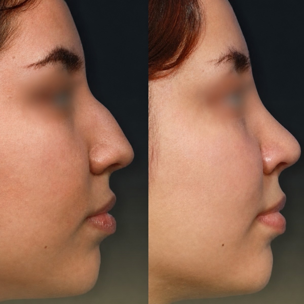 Resultados antes y después de rinoplastia de punta en Memorial Bahçelievler Hospital, nariz refinada