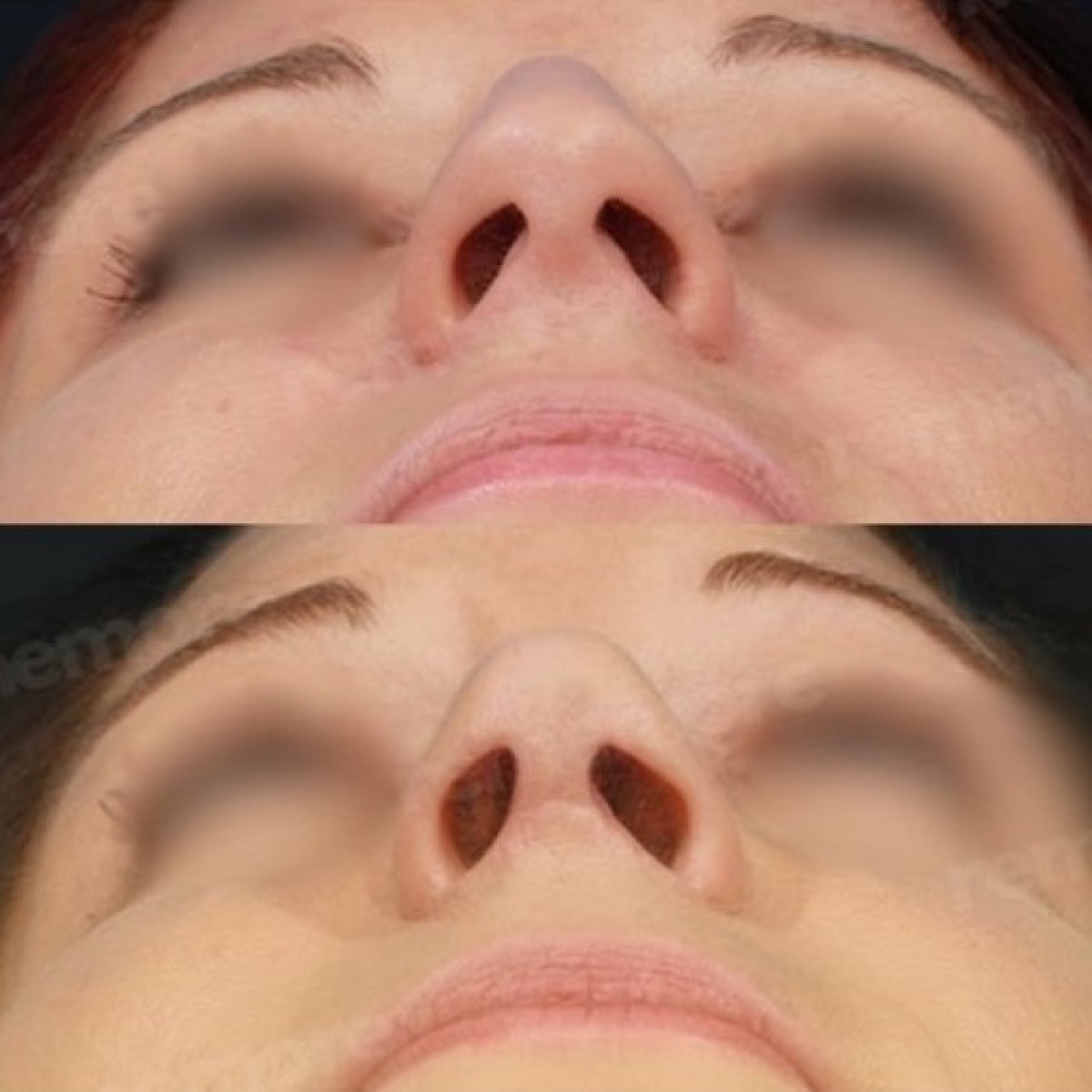 Before and after tip rhinoplasty results at Memorial Bahçelievler Hospital, refined nose tip