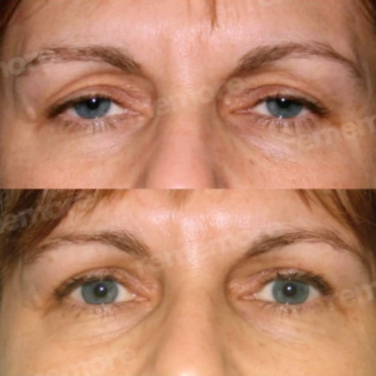 Resultados de blefaroplastia antes y después en Memorial Bahçelievler Hospital, corrección de párpados