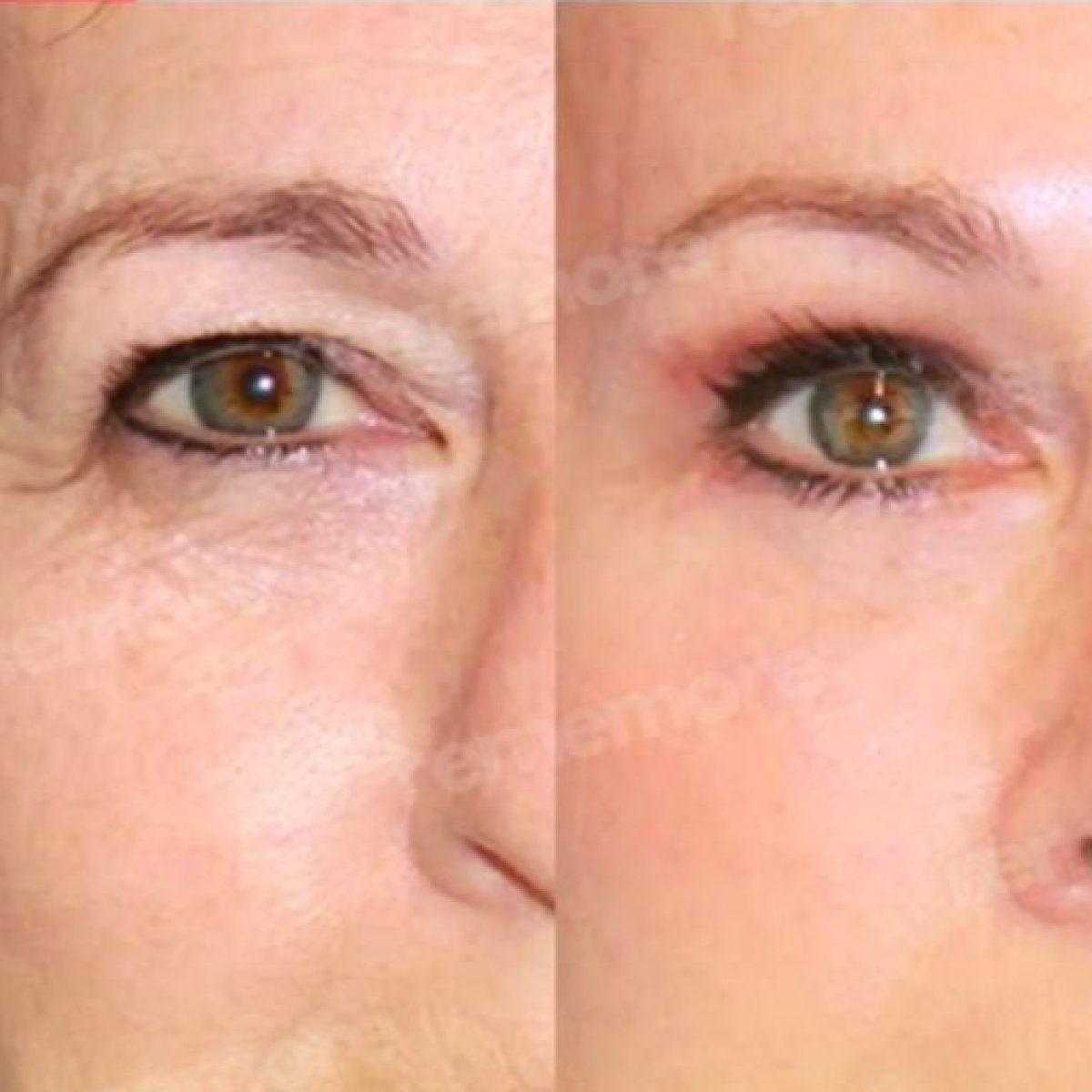 Resultados de blefaroplastia antes y después en Memorial Bahçelievler Hospital, corrección de párpados