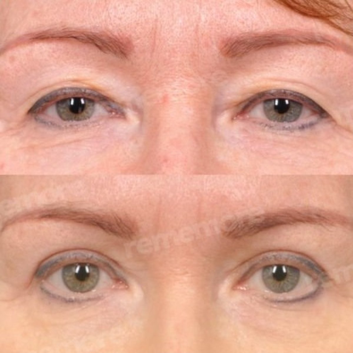 Resultados de blefaroplastia antes y después en Memorial Bahçelievler Hospital, corrección de párpados