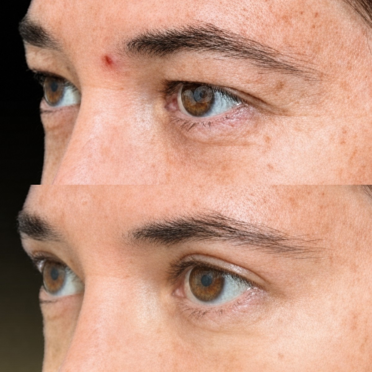 Before and after blepharoplasty results at Memorial Bahçelievler Hospital, eyelid correction