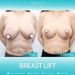 Before and after Увеличение груди photos by Dr. Jiraroch Meevassana