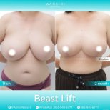 Before and after Увеличение груди photos by Dr. Jiraroch Meevassana