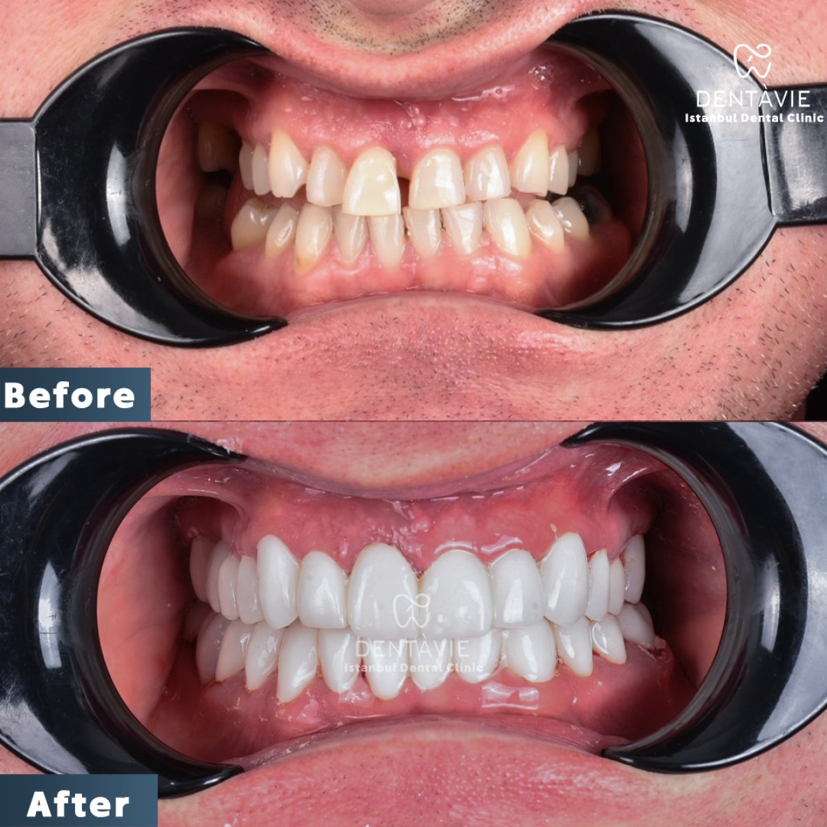 نتائج قبل وبعد ابتسامة هوليود في Dentavie Istanbul Dental Clinic، تغيير الابتسامة