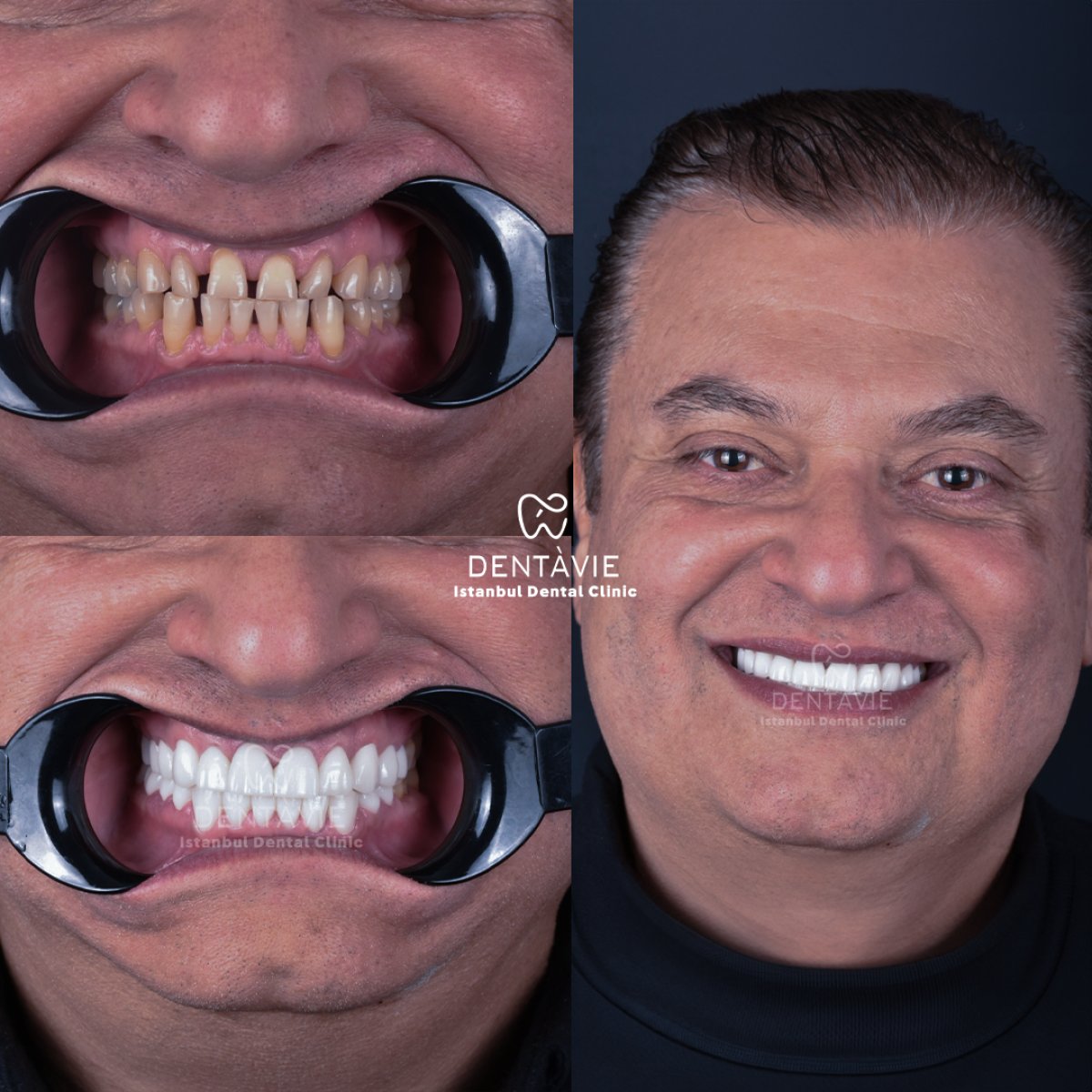 نتائج قبل وبعد ابتسامة هوليود في Dentavie Istanbul Dental Clinic، تحول الابتسامة