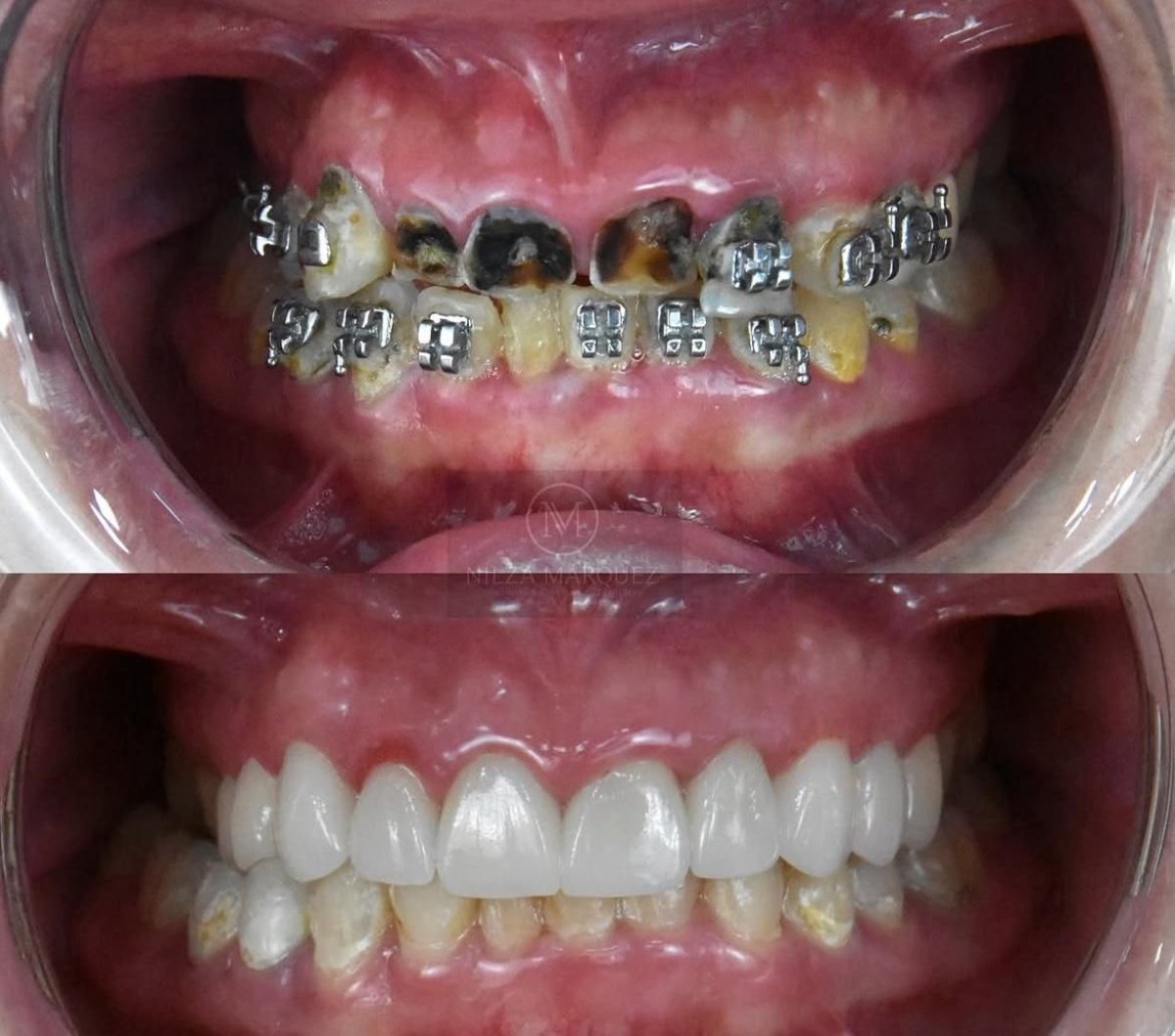 До и после установки циркониевых коронок в DDS Nilza Márquez Dental Practice, результат улыбки