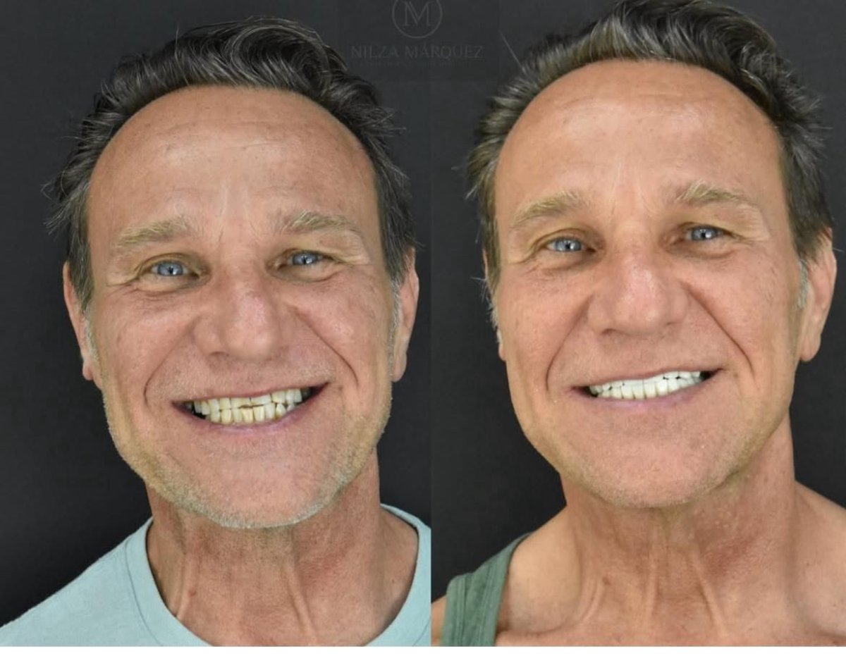 نتائج قبل وبعد تركيب تيجان الزركونيا في DDS Nilza Márquez Dental Practice، ترميم الابتسامة