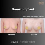 Before and after Увеличение груди photos by Dr. Dr Phatcharasak Kraisornphongsakul Md