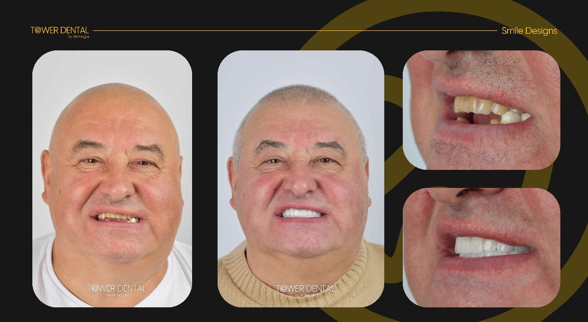 نتائج قبل وبعد تركيب تيجان الأسنان في Tower Dental Clinic، تحسين مظهر الابتسامة