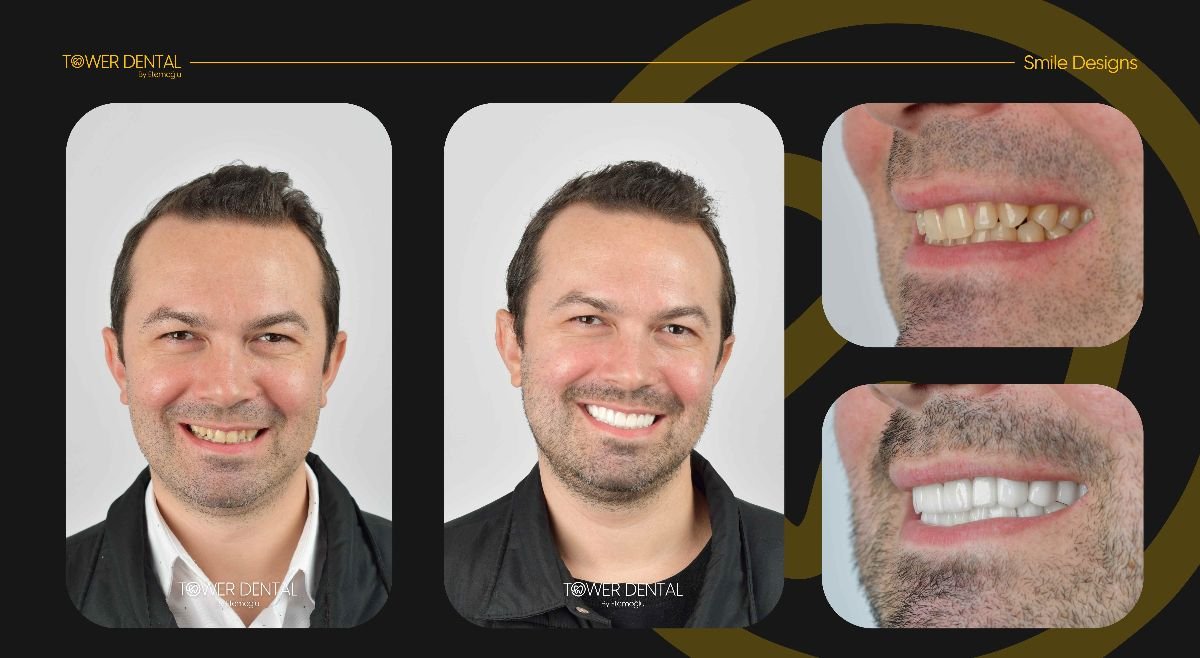 نتائج قبل وبعد تركيب تيجان الأسنان في Tower Dental Clinic، تحسين مظهر الابتسامة