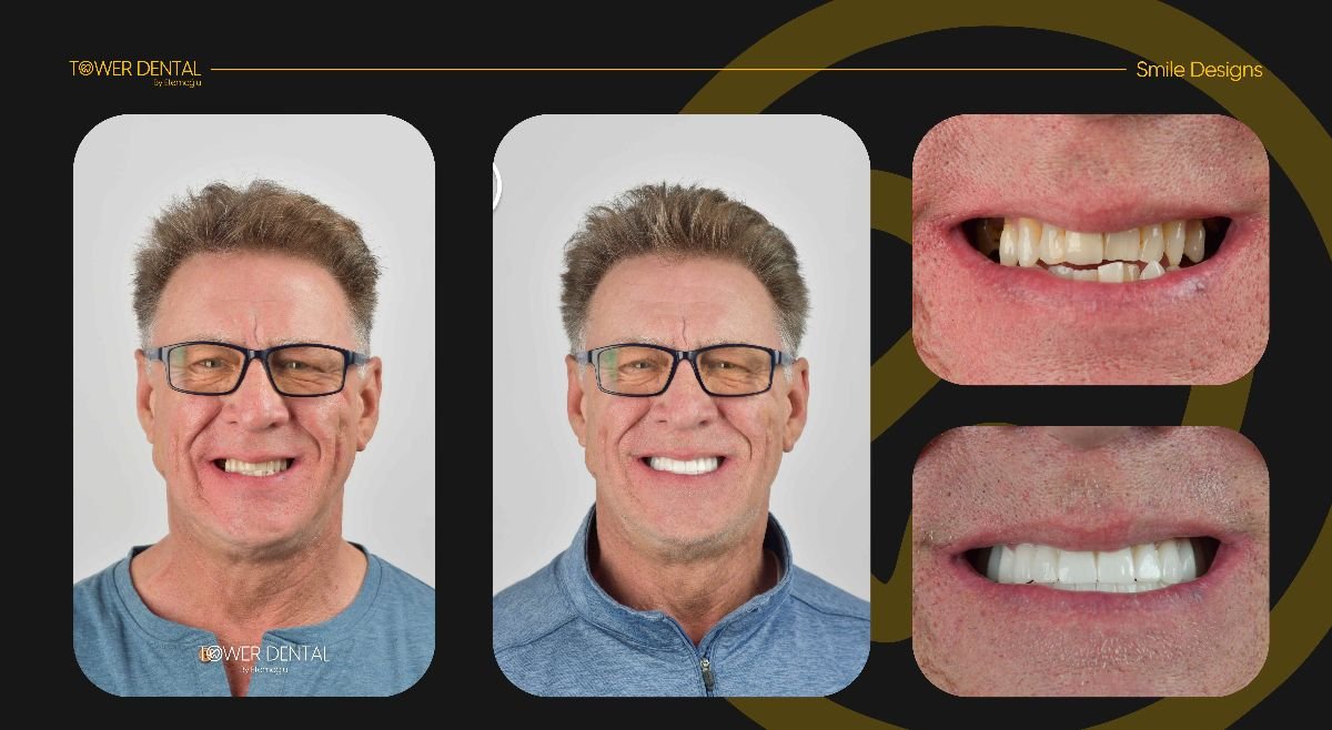 Résultats avant et après couronnes dentaires à Tower Dental Clinic, sourire amélioré