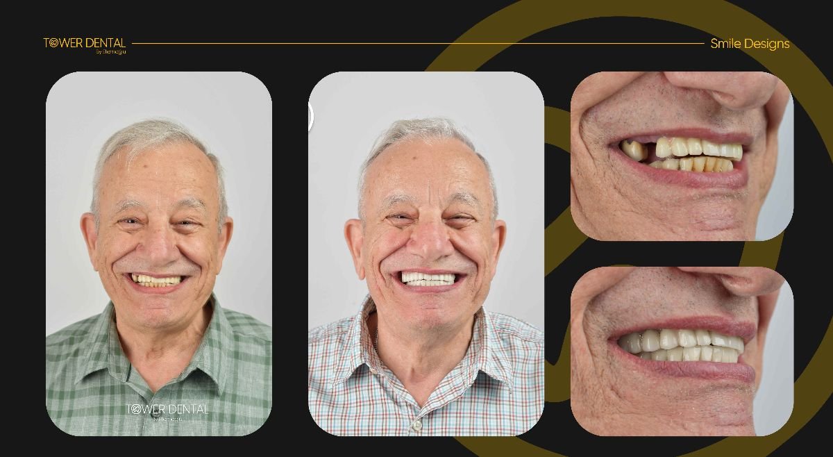 نتائج قبل وبعد تركيب تيجان الأسنان في Tower Dental Clinic، تحسين تصميم الابتسامة