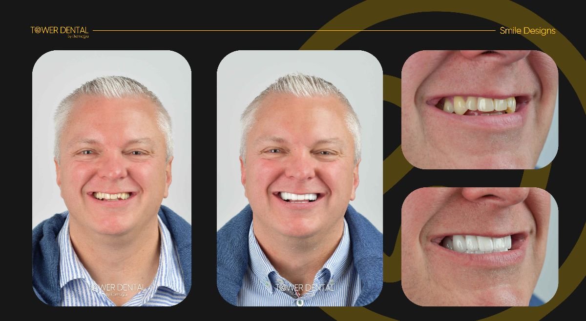 نتائج قبل وبعد تركيب تيجان الأسنان في Tower Dental Clinic، تحسين جمالية الابتسامة