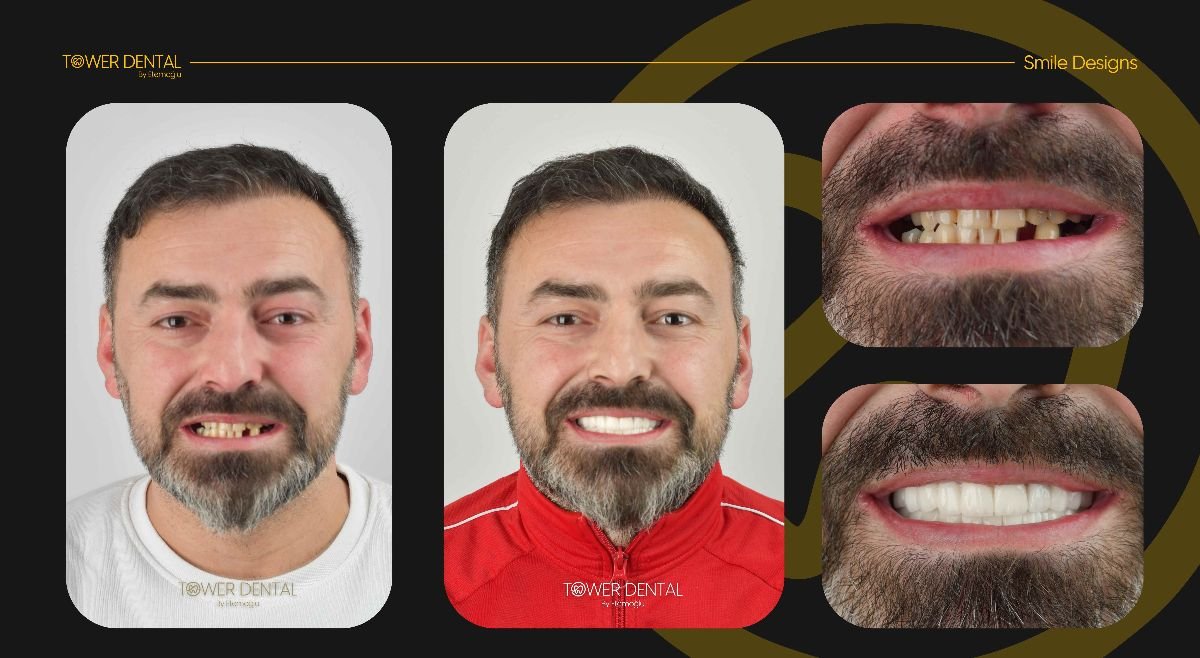 قبل وبعد تركيب تيجان الأسنان في Tower Dental Clinic، نتيجة استعادة الابتسامة