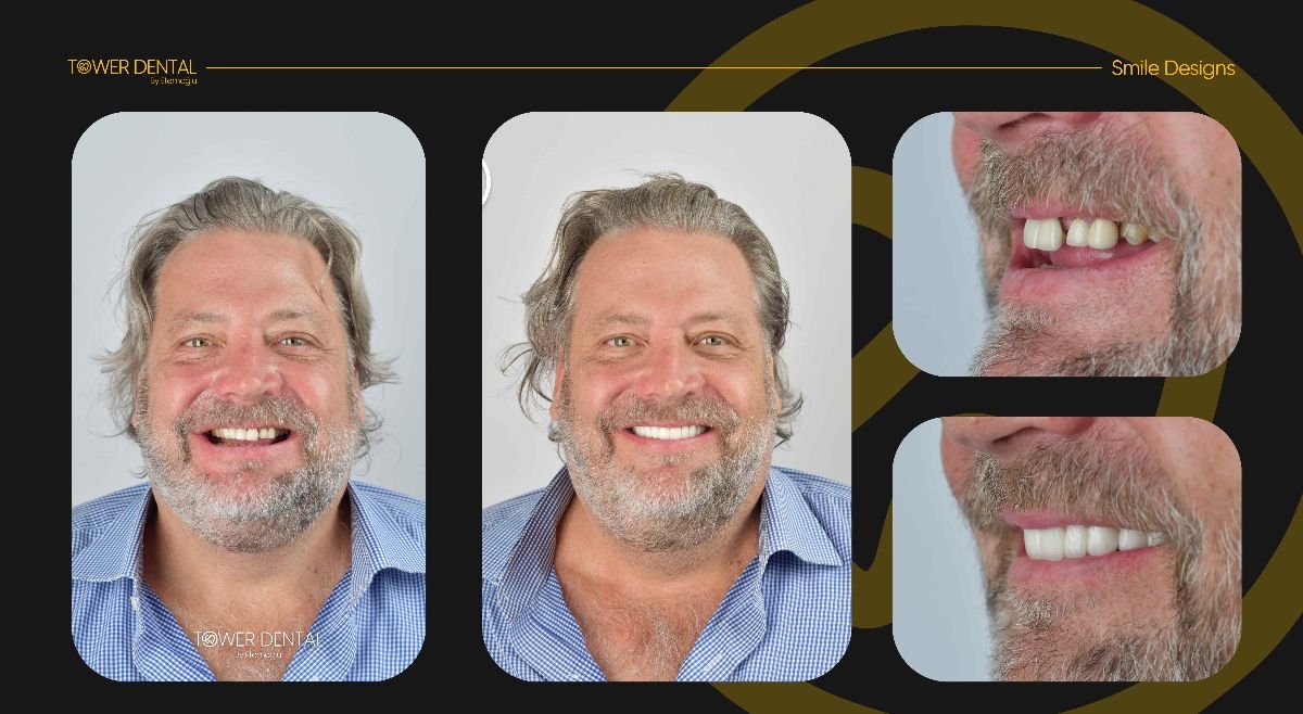 Résultats avant et après couronnes dentaires à Tower Dental Clinic, sourire amélioré