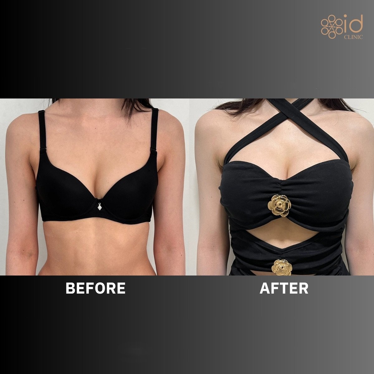 Before and after breast augmentation with tear drop implants at ID Clinic Bangkok, visible result