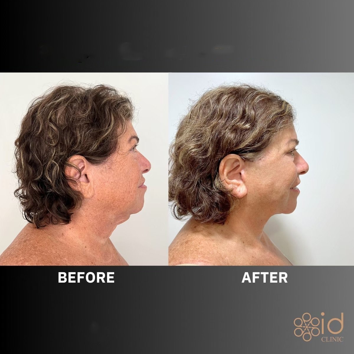 Deep plane facelift before and after results at ID Clinic Bangkok, visible facial rejuvenation