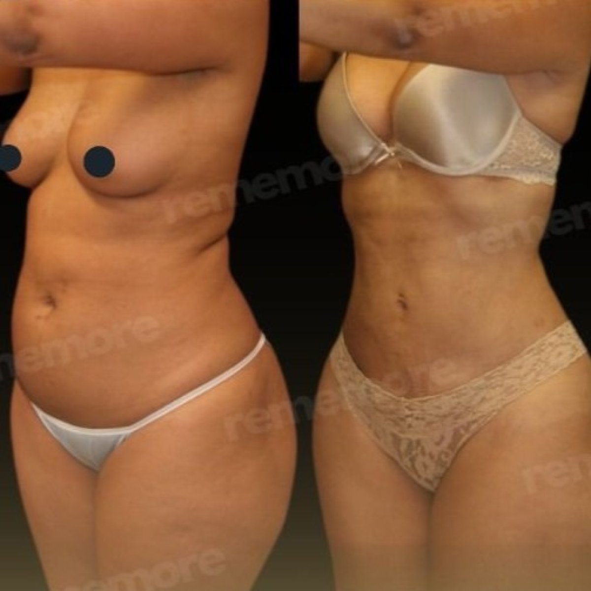 Before and after Vaser liposuction results at Memorial Bahçelievler Hospital, body contouring