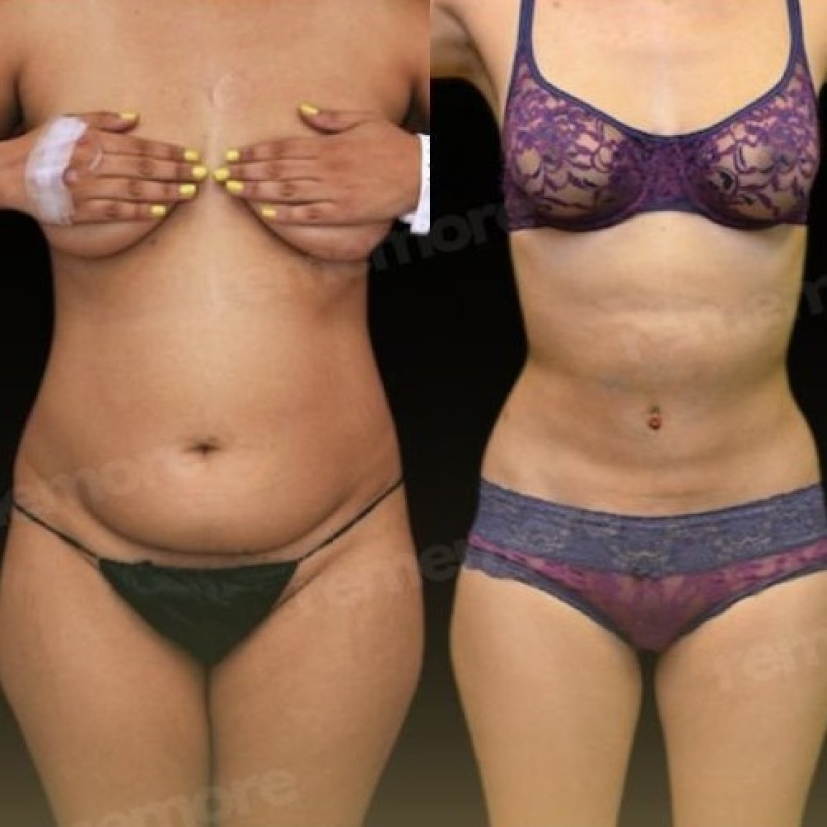 Before and after Vaser liposuction results at Memorial Bahçelievler Hospital, body contouring