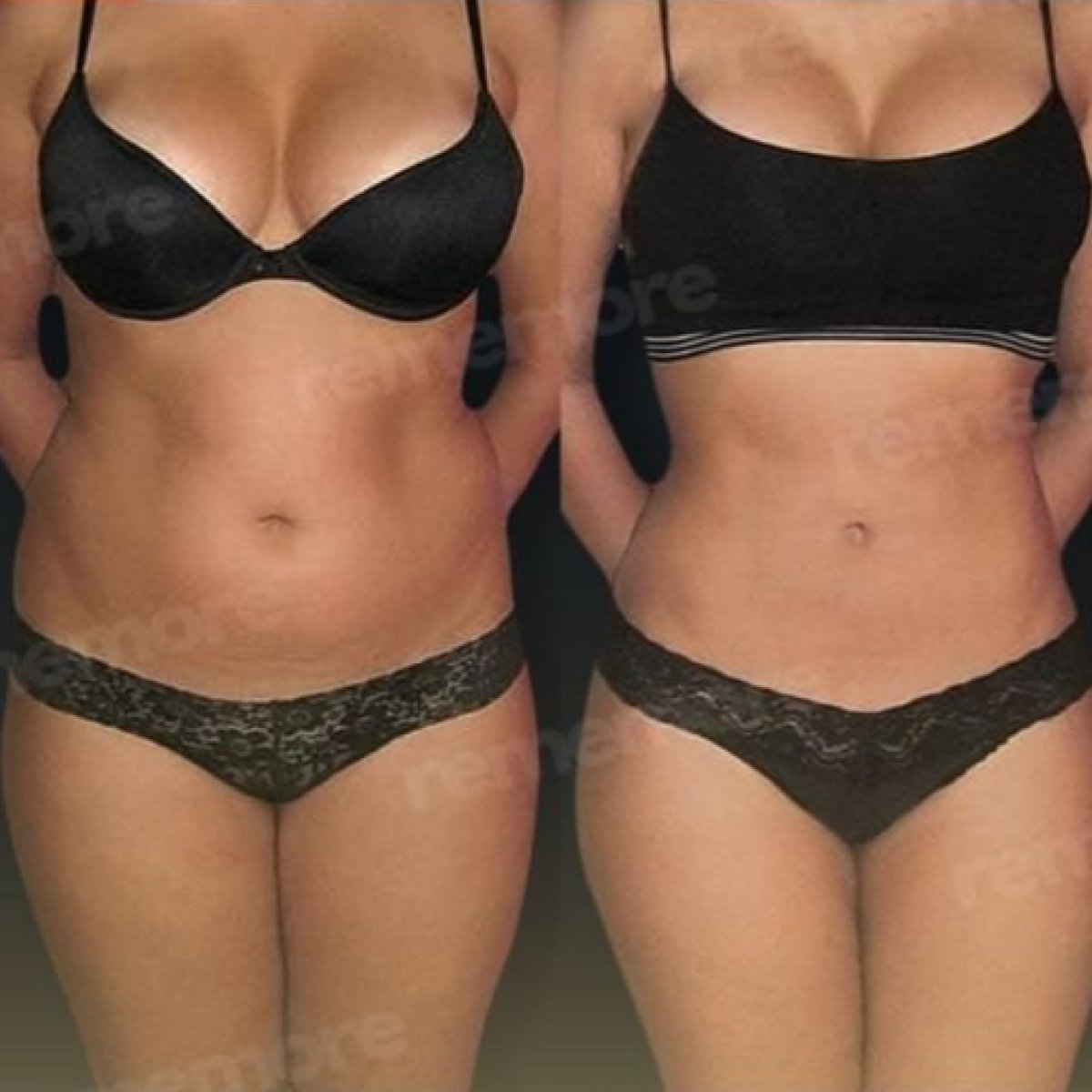 Before and after Vaser liposuction results at Memorial Bahçelievler Hospital, body contouring