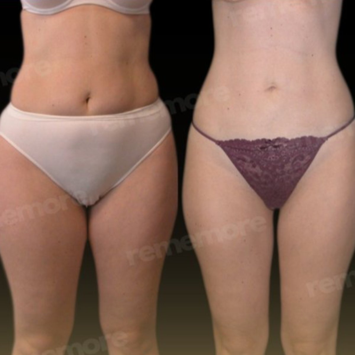 Before and after Vaser liposuction results at Memorial Bahçelievler Hospital, body contouring