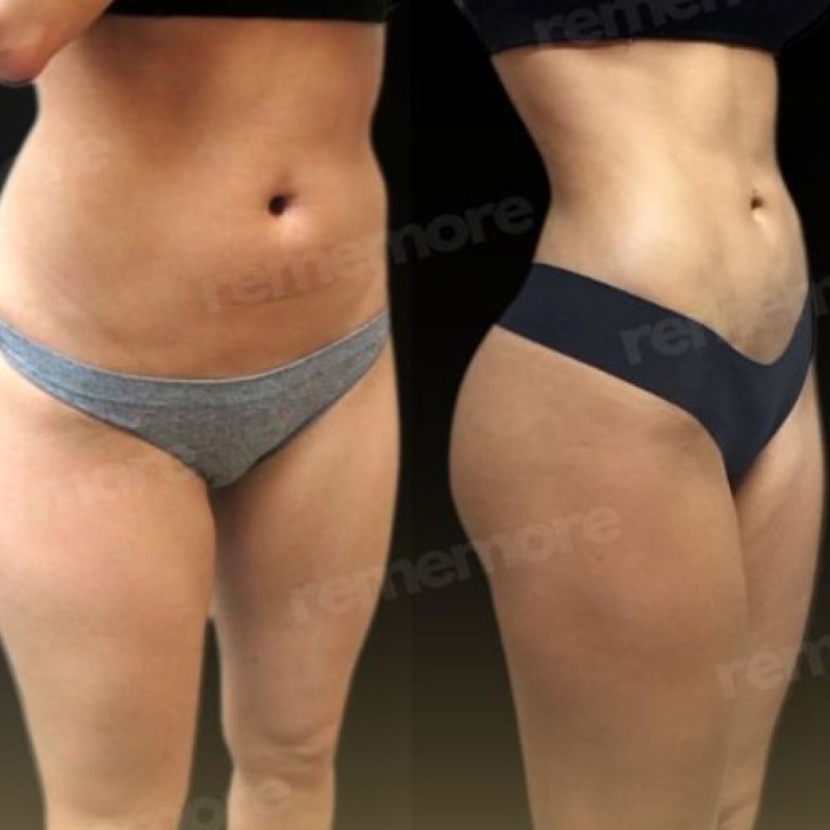 Résultats avant/après liposuccion Vaser à Memorial Bahçelievler Hospital, remodelage corporel