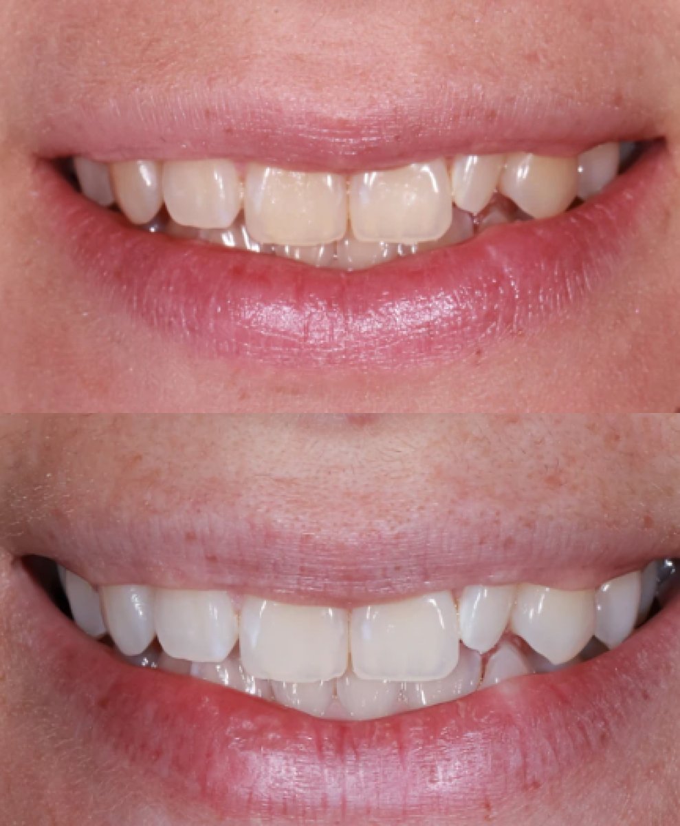 Resultados antes y después de limpieza dental (scaling) en Atelier Uśmiechu, sonrisa más blanca