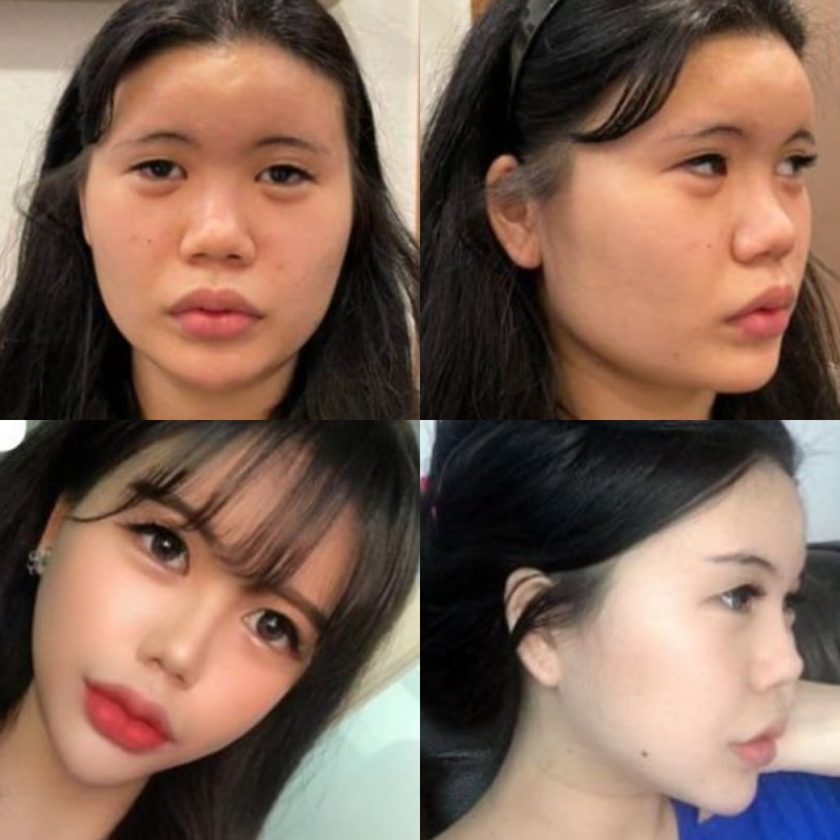 نتائج قبل وبعد إزالة دهون الخدود في VG Plastic Surgery، تحديد أوضح للوجه