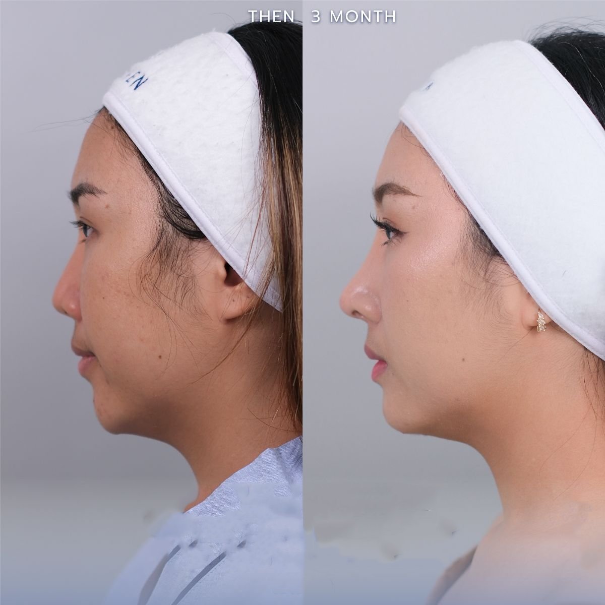 Resultado de cirugía de feminización facial antes y después en Dr. Chen Surgery Hospital International Center