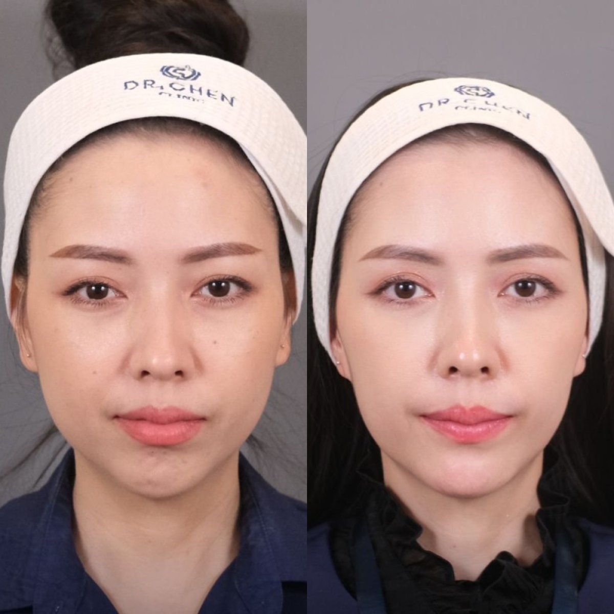 Resultado de cirugía de feminización facial antes y después en Dr. Chen Surgery Hospital International Center