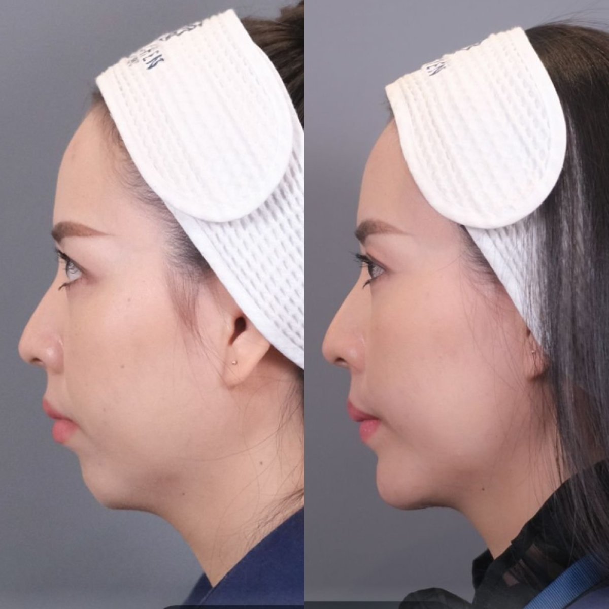 Resultado de cirugía de feminización facial antes y después en Dr. Chen Surgery Hospital International Center