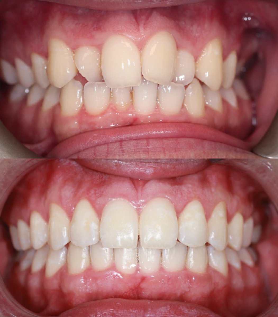 نتائج قبل وبعد تقويم Invisalign في Atelier Uśmiechu، تحسين انتظام الأسنان