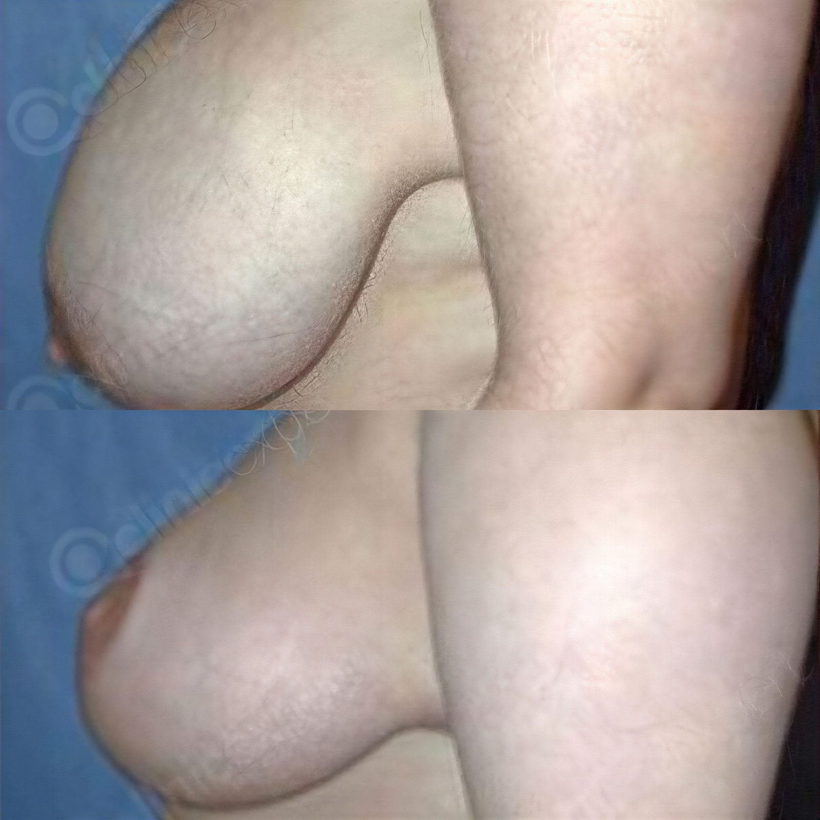 Resultados de lifting de senos antes y después en CE International Hospital, mejor contorno