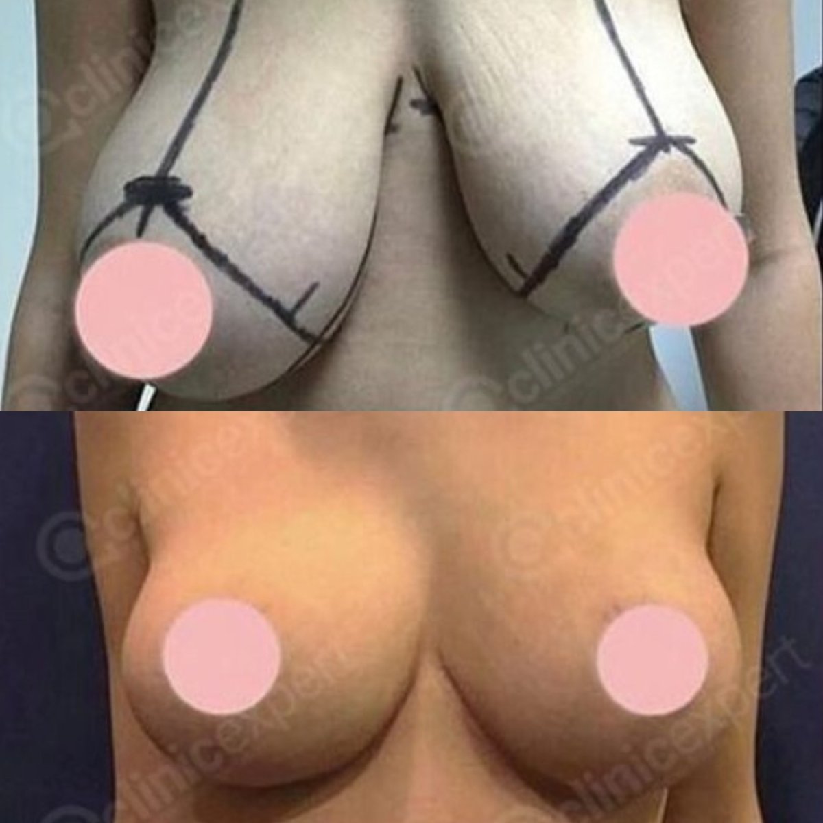 Résultats avant et après lifting des seins à CE International Hospital, contour amélioré